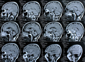 Die Chemotherapie-Behandlung von Tumoren kann mittels KI-Unterstützung abgemildert werden.