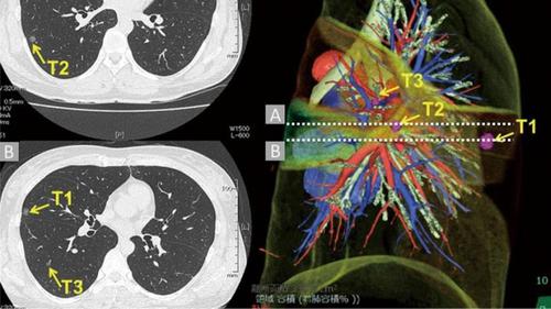 Ein hochauflösender CT-Scan einer Lunge, wie ihn das National Cancer Institute den Teilnehmern zur Verfügung gestellt hat. (c) National Cancer Institute