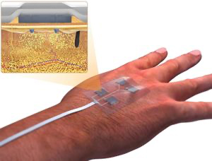 Der Hightech-Verband erlaubt präzise Medikamentation.